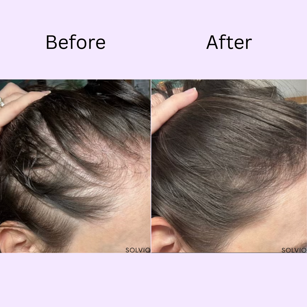 Solvio Hair Growth Accelerator
